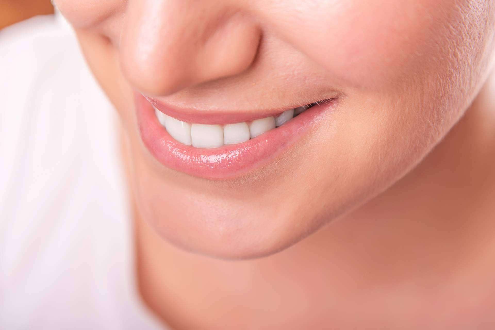 Las restauraciones estéticas a través de carillas de composite que realiza Corrales Dental