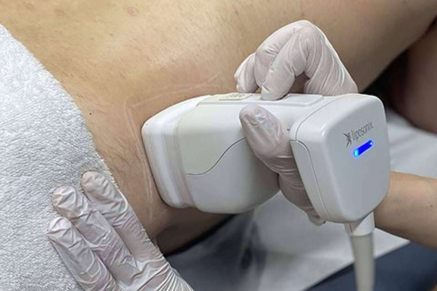 El tratamiento reductor de la grasa localizada sin dolor ni cirugía, Liposonix