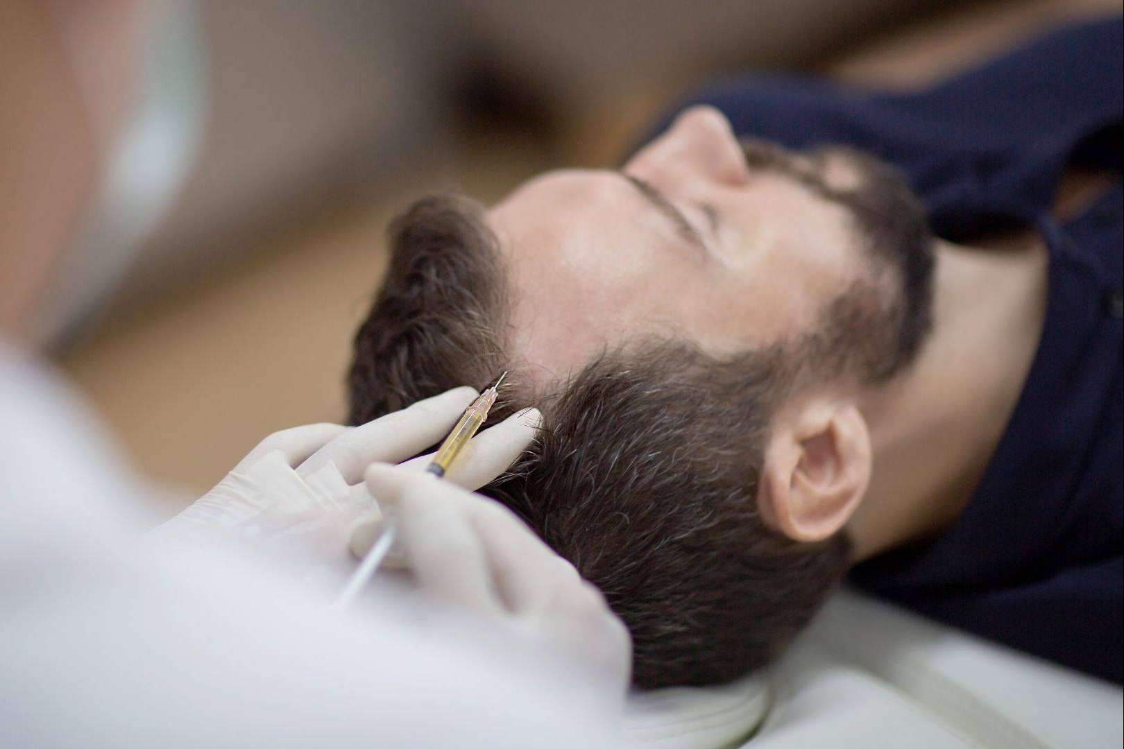 El plasma rico en plaquetas y dutasterida es una potente terapia regenerativa de doble efecto contra la caída del cabello