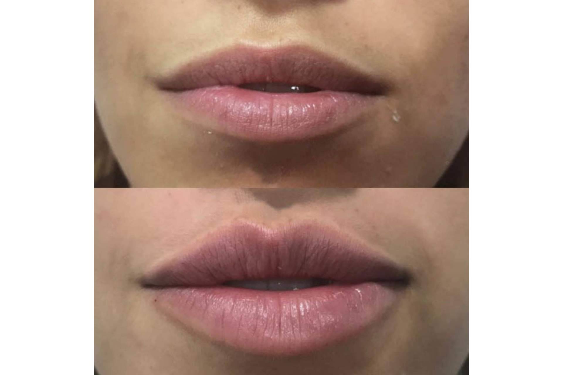 ¿Se puede conseguir un aumento de labios en Madrid con resultados naturales?, por la Dra. Cecilia Arthur