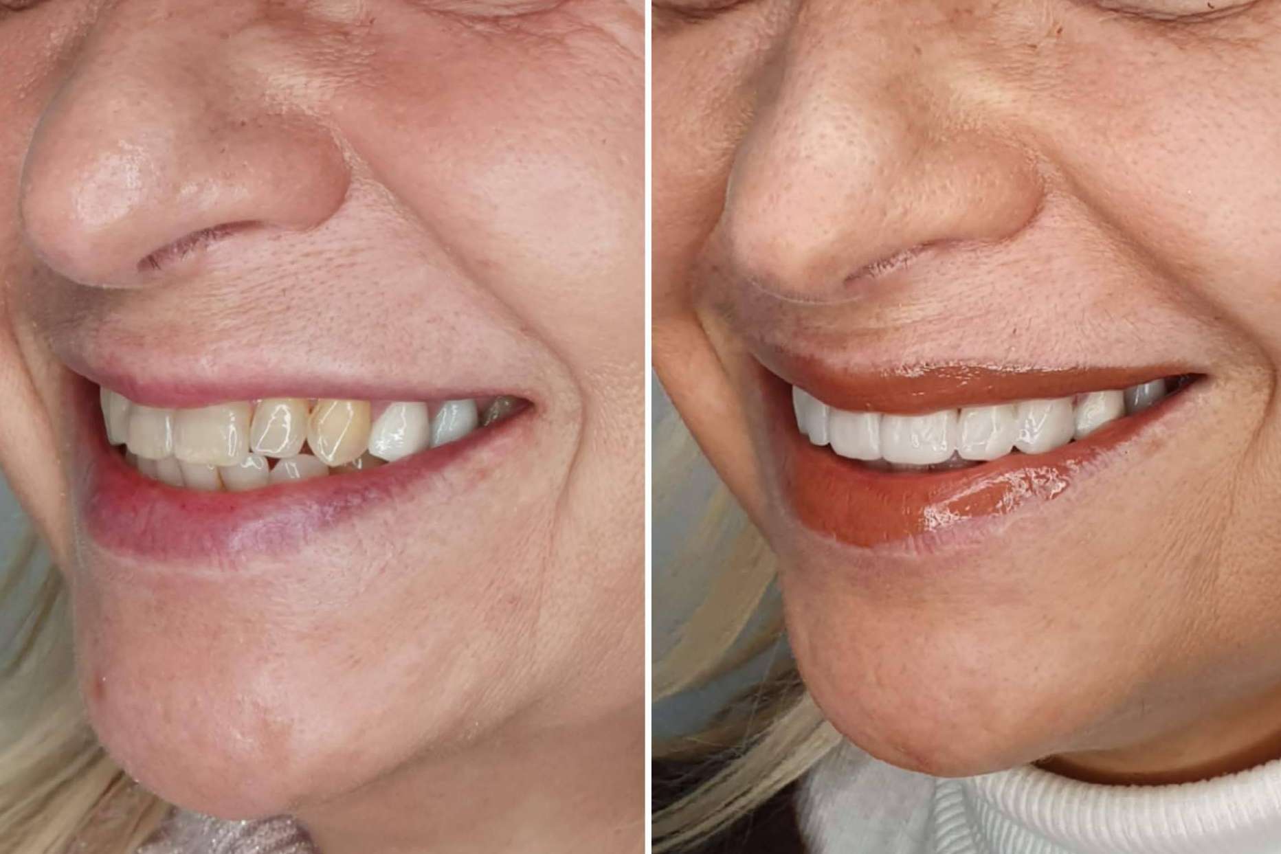Alineación dentaria sin ortodoncia, por Dentinova
