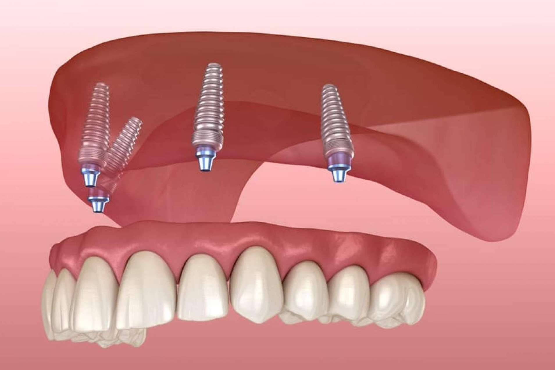 Clínica Dental Crespí & Gandía encuentra la técnica de rehabilitación oral perfecta para cada caso