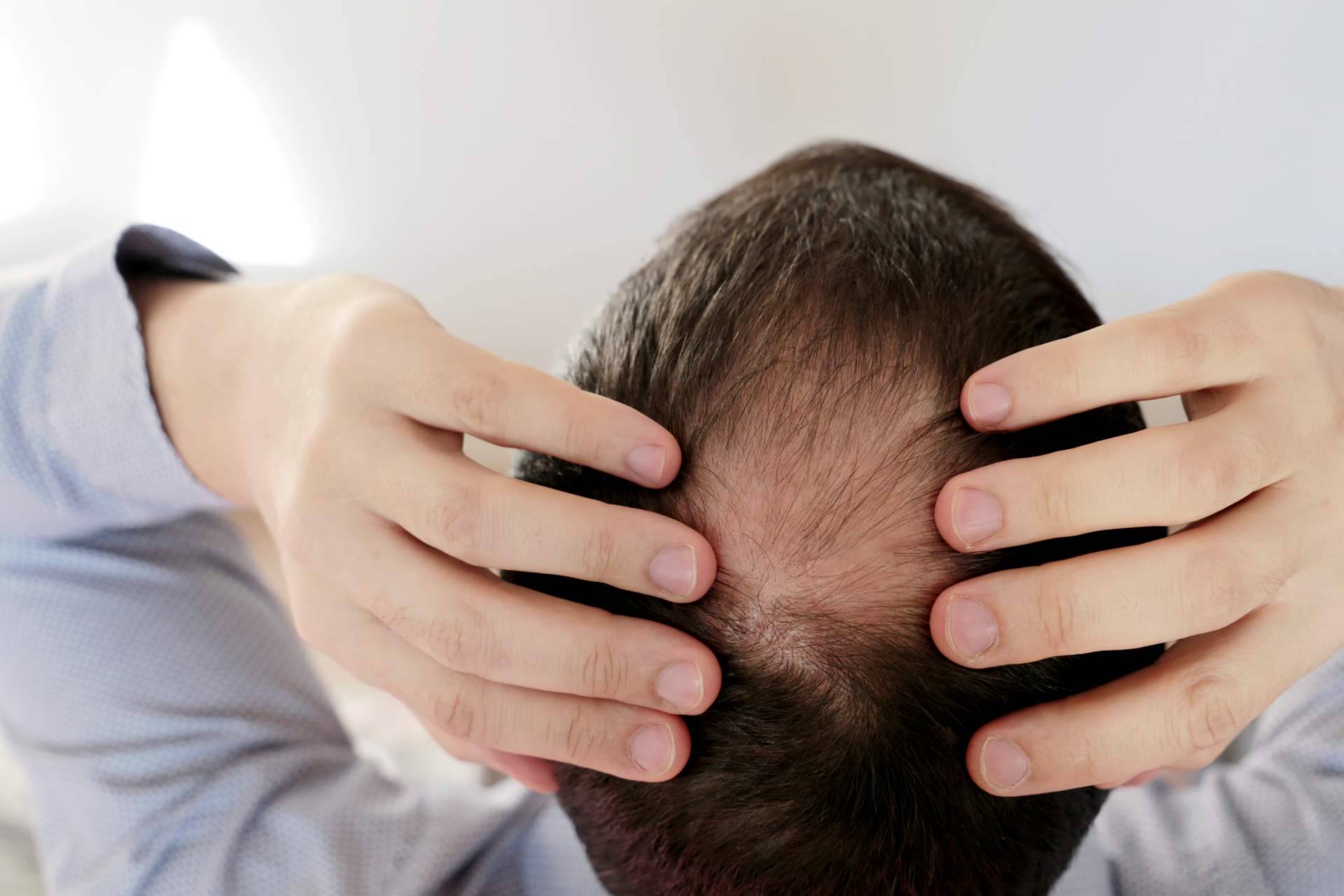 ¿Por qué el trasplante de pelo en la coronilla es la solución definitiva para la alopecia en esta zona?