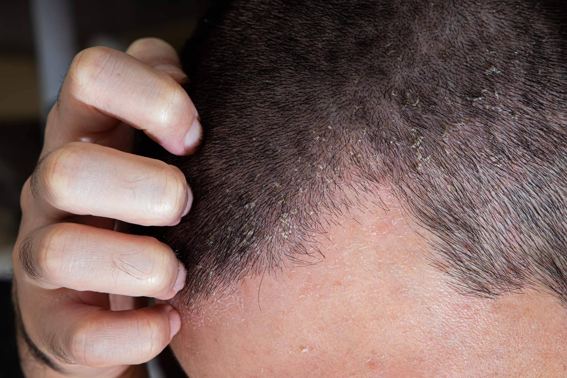 Una afección que puede provocar alopecia si no se trata es la dermatitis seborreica