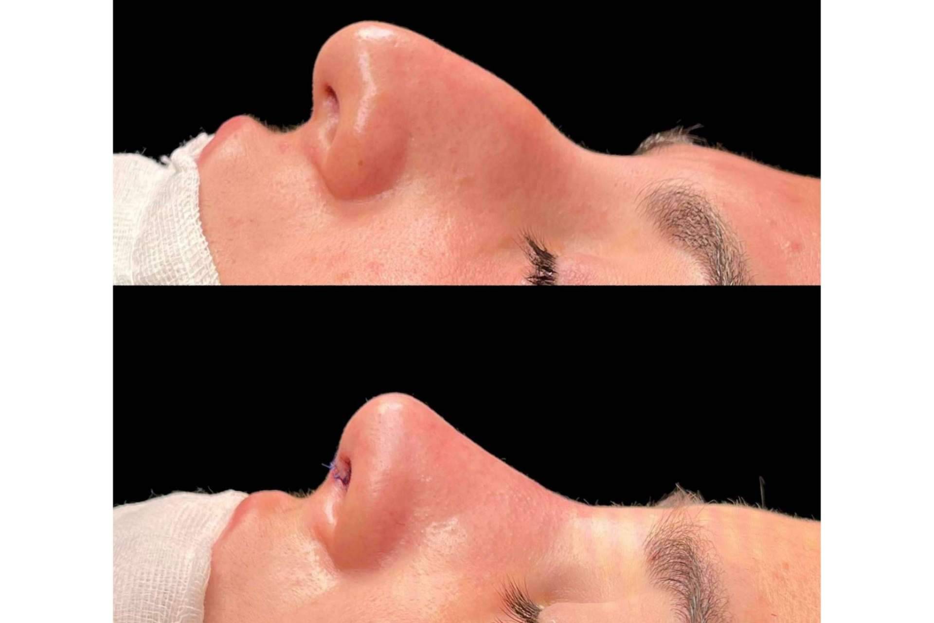 De qué manera recuperarse de una rinoplastia, de la mano del Dr. Pérez Villar