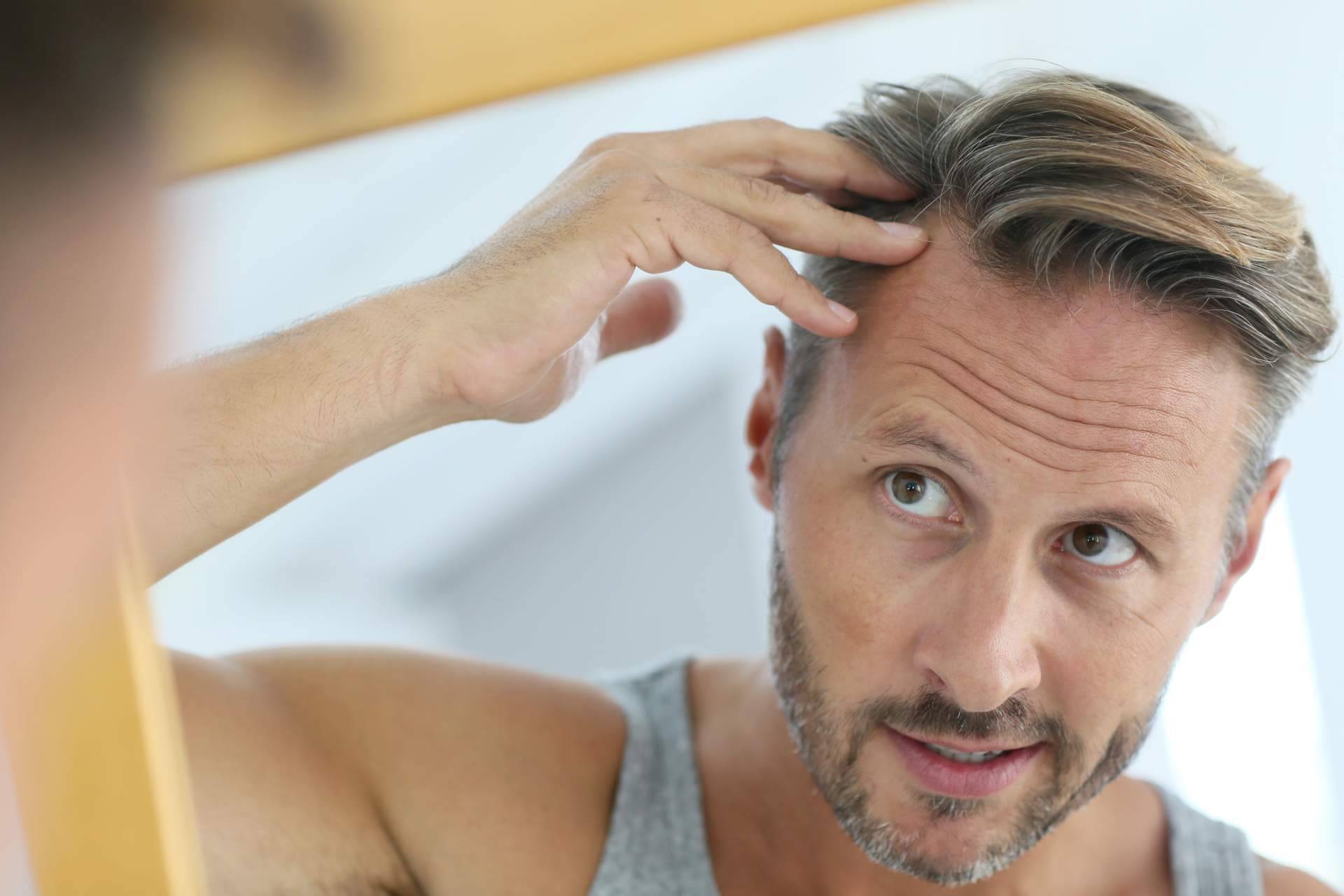 ¿Cuál es la mejor edad para hacerse un injerto capilar?, por MC360