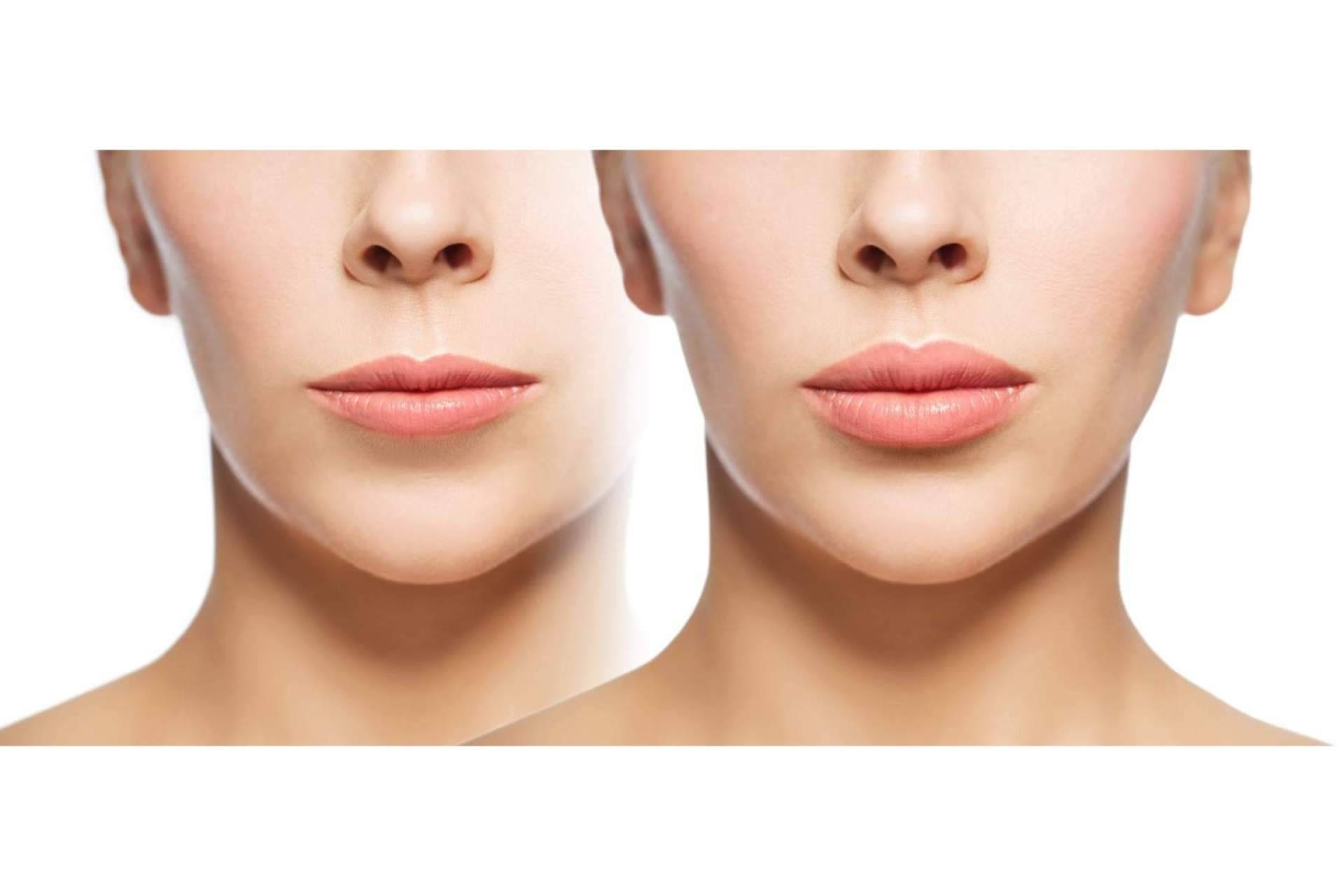 Bio-revitalización con mesoHYAC-16 by mesoINSTITUTE