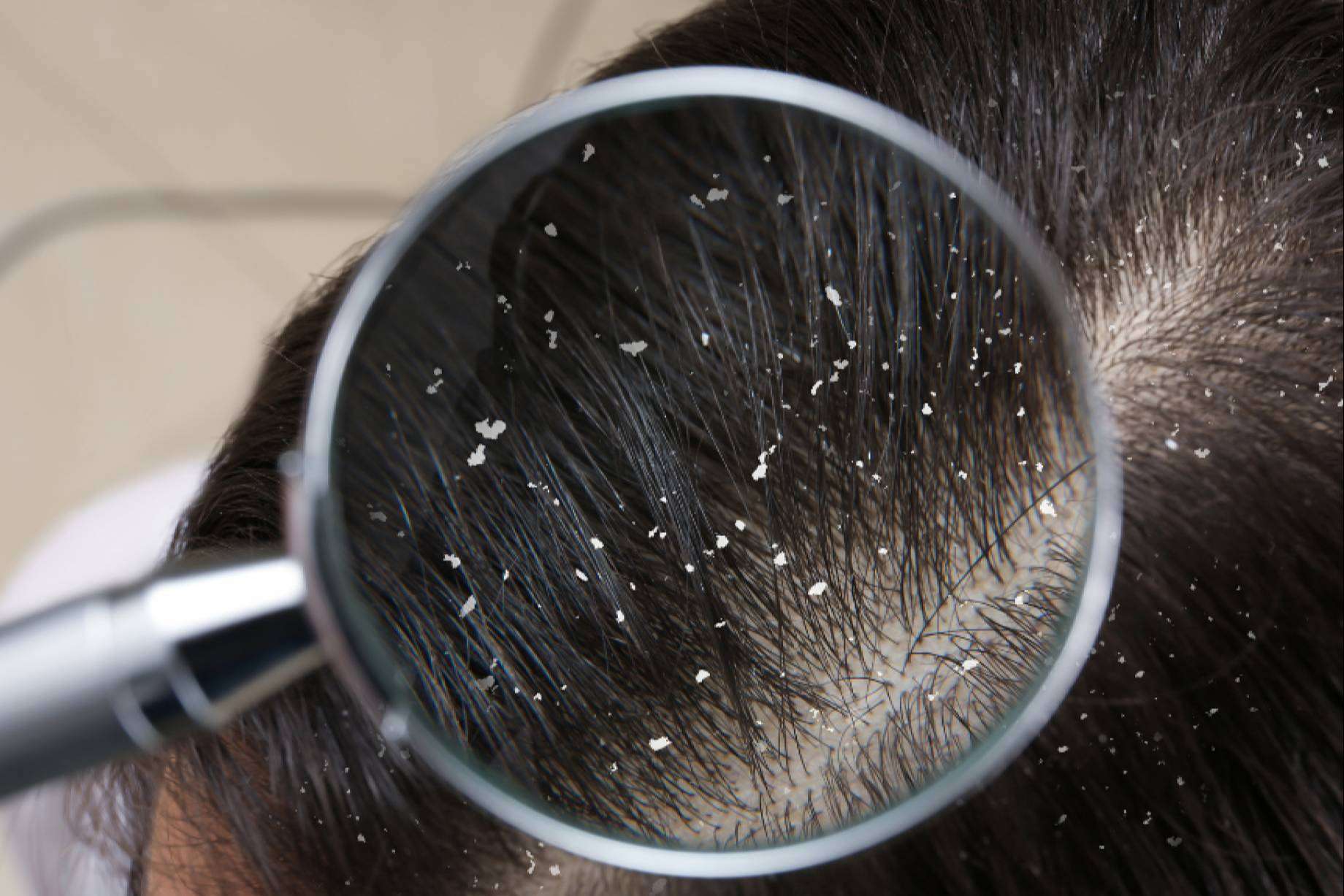 La caspa, ¿culpable de la caída del cabello?