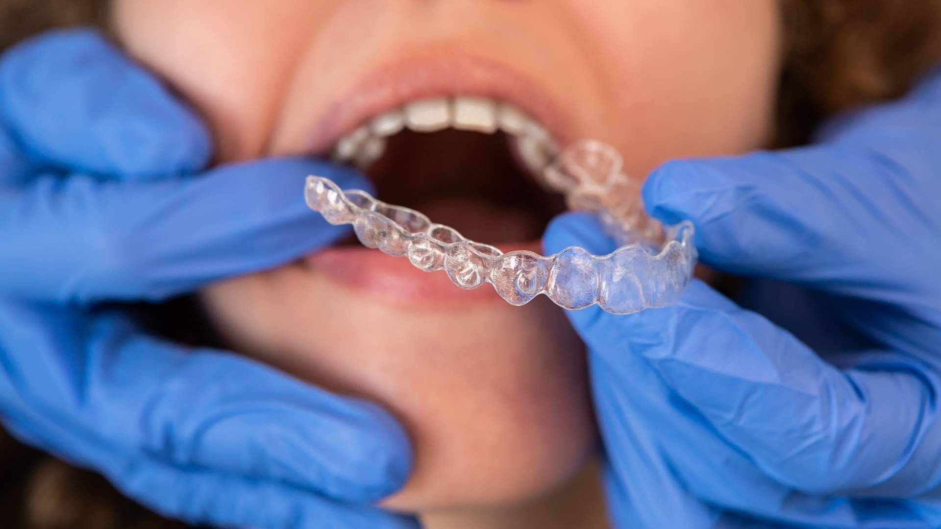 Tratamientos de ortodoncia invisible en Málaga de la mano de Clínica Dentinos