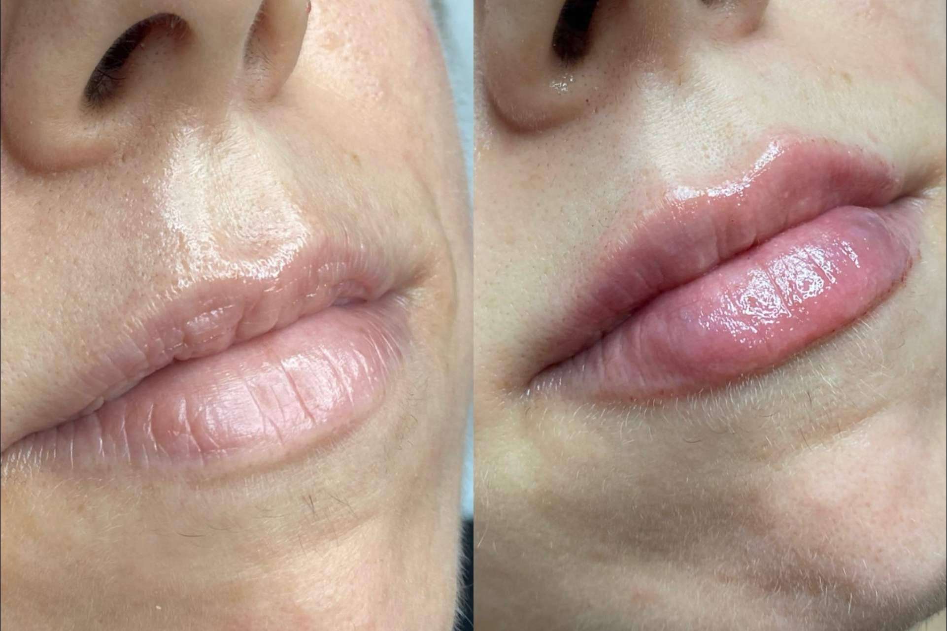 La técnica en dos pasos de la doctora Sandra Hermida para unos labios 100 % naturales