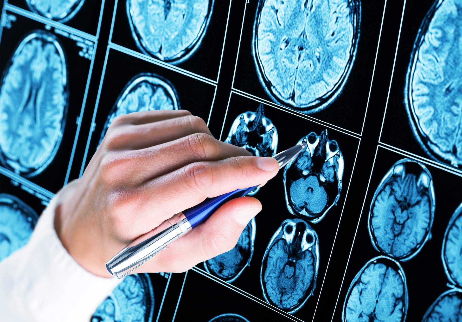 Alzhéimer, una enfermedad cuya cura se hace esperar, aunque se avanza