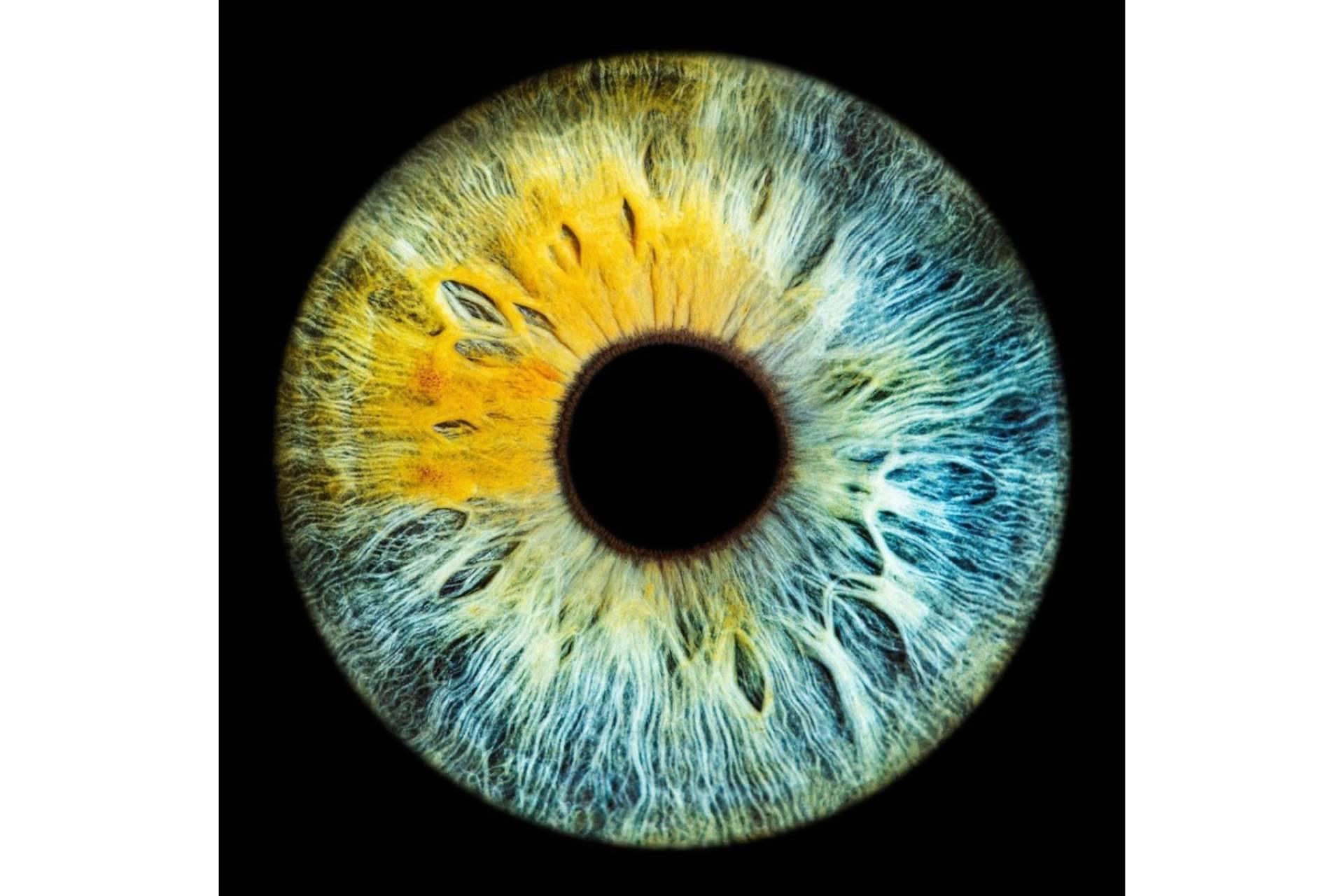 Clínica Eyecos presenta algunas celebridades con heterocromía ocular
