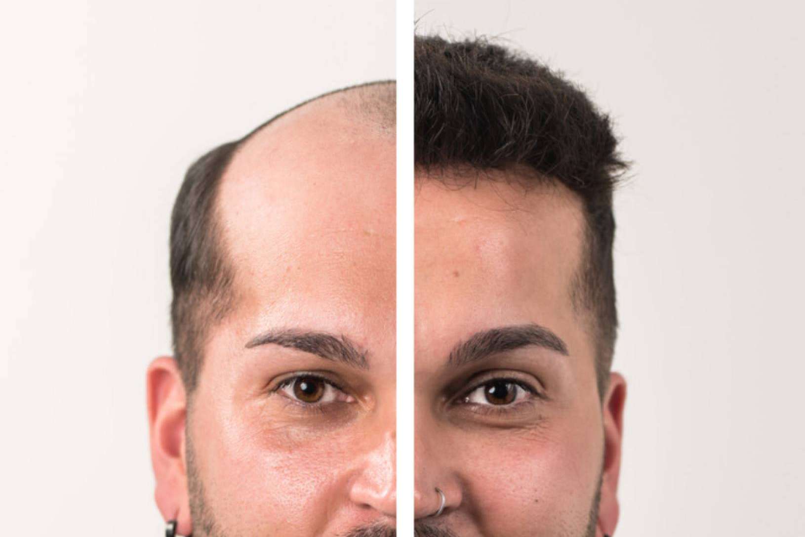 Un mercado en auge, las prótesis capilares para hombre con Hair Inspira