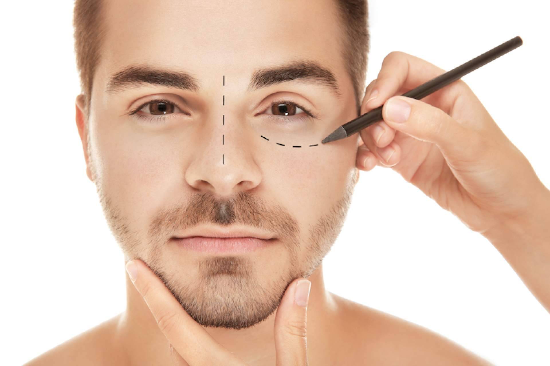 Blefaroplastia no quirúrgica para el tratamiento de párpados superiores así como inferiores cuando existe piel redundante