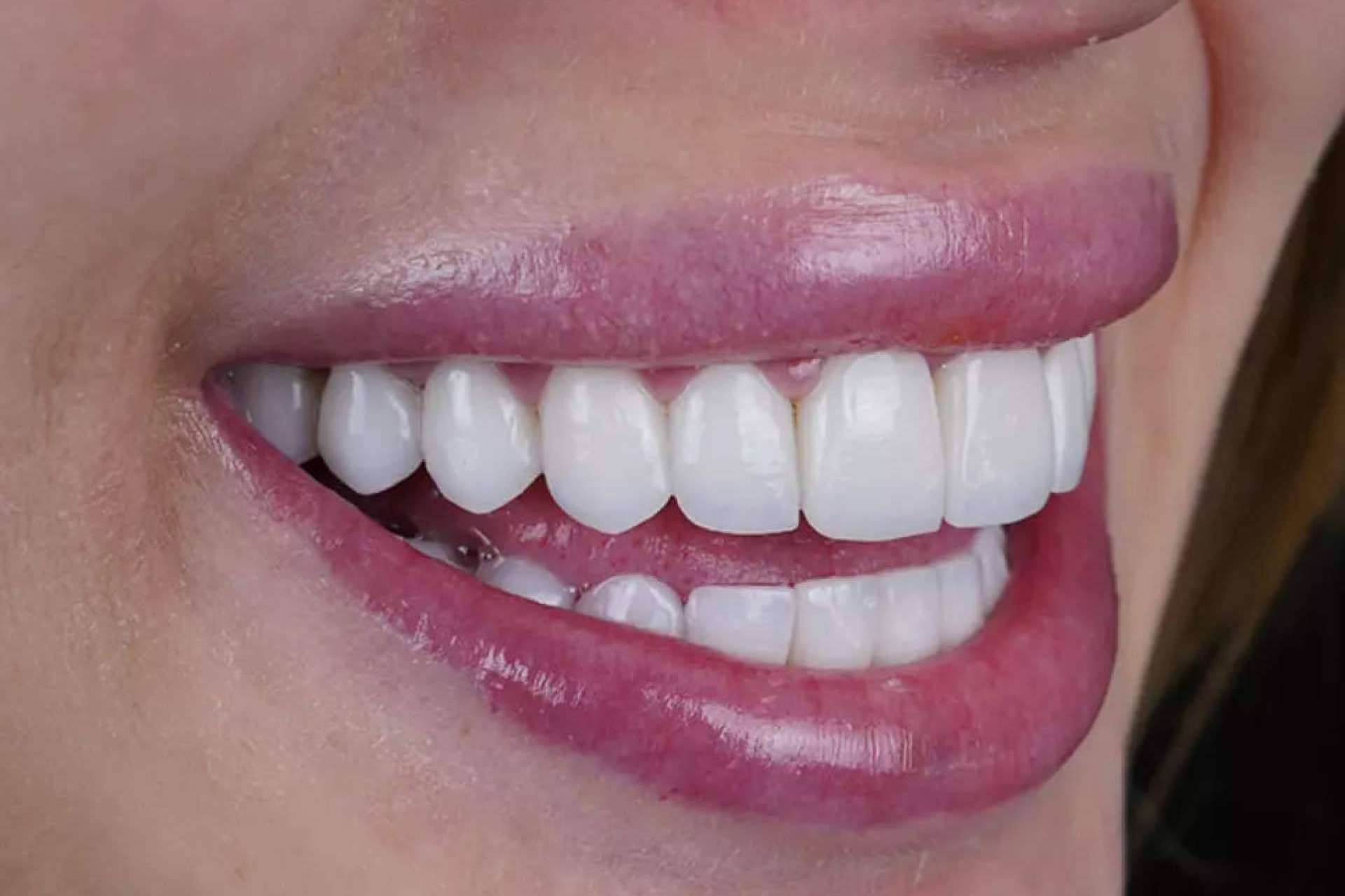 Denty Dent mejora la sonrisa de sus pacientes con tratamientos de estética dental
