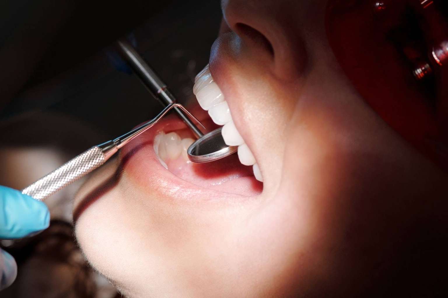 ¿Qué son las carillas dentales? Lola Escalante