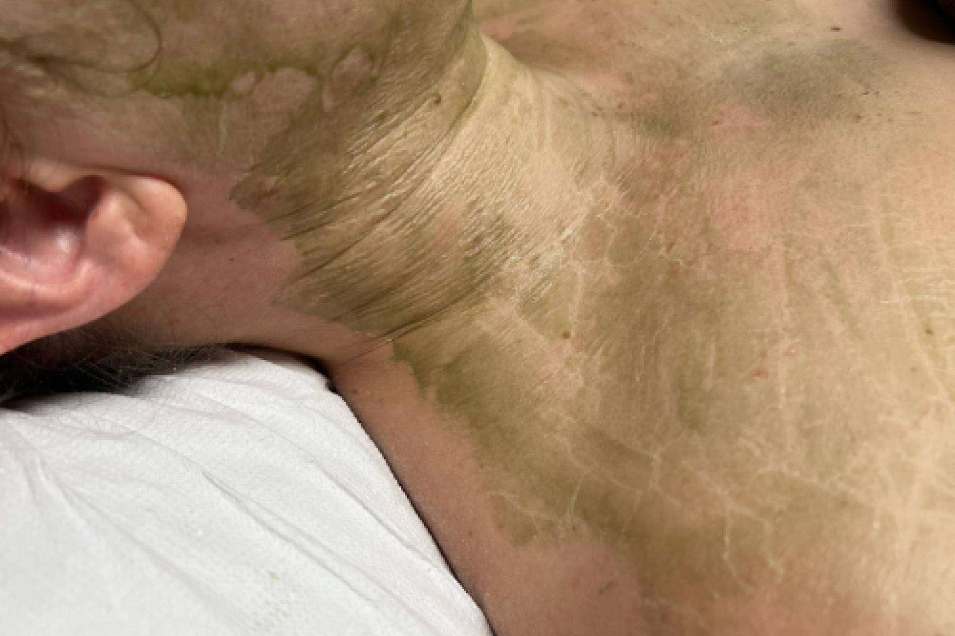 Mascarilla enzimática cosmedique y la revolución en los centros de estética