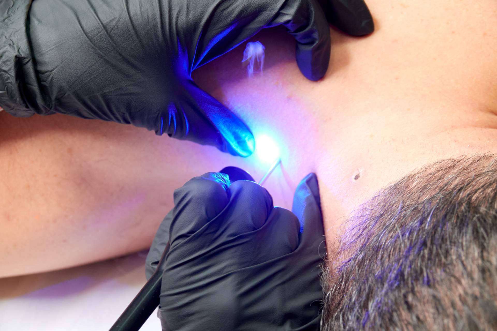 Blumed es el láser azul para una piel perfecta