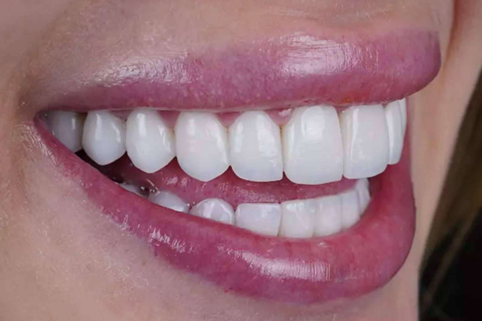 Tratamientos de estética dental con los especialistas de Denty Dent