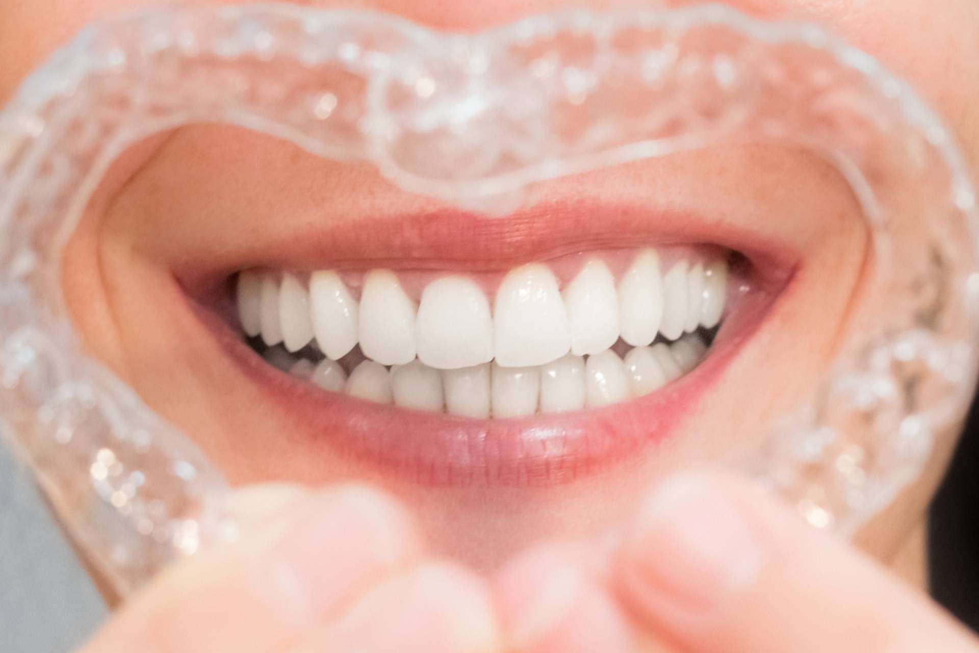 Lograr una apariencia radiante de la dentadura gracias al blanqueamiento dental avanzado con luz LED