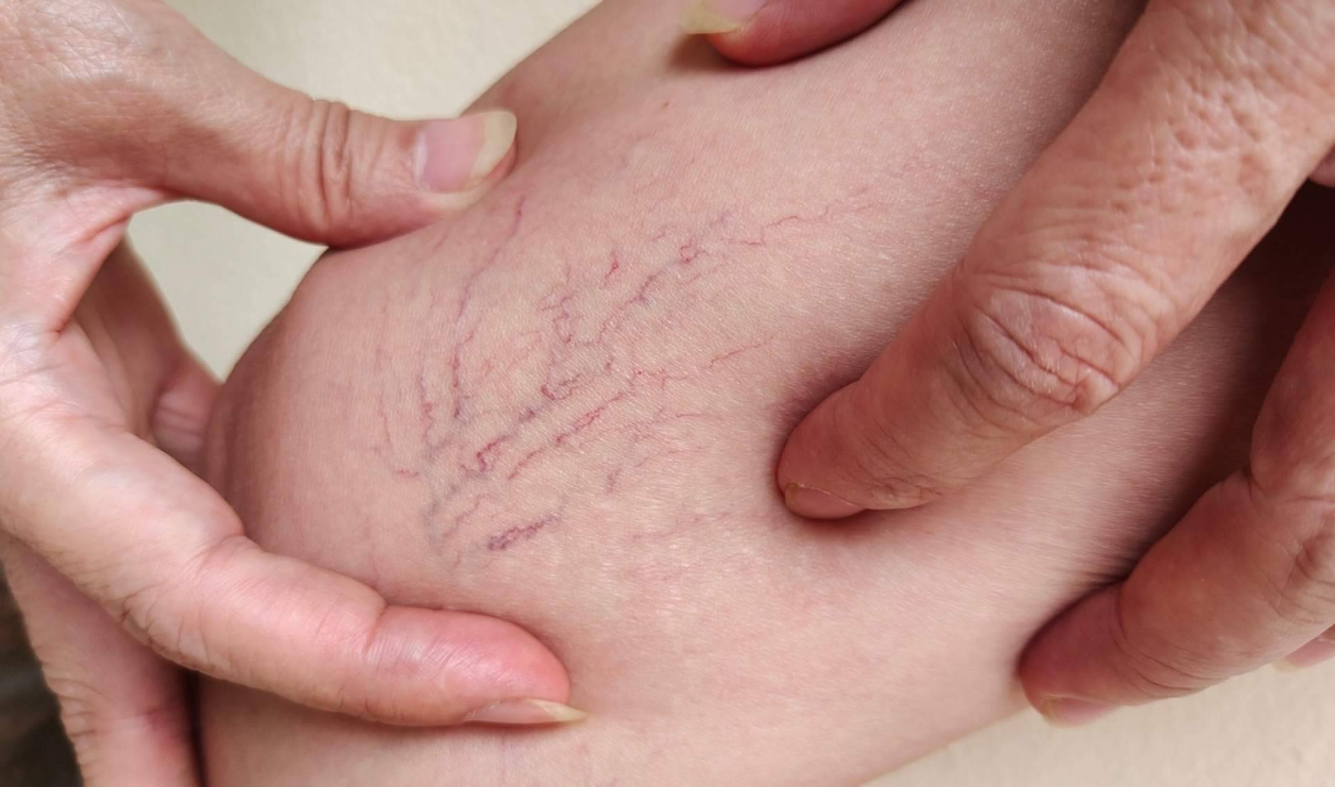 ¿Dónde encontrar especialistas en la eliminación de varices? Elegansse