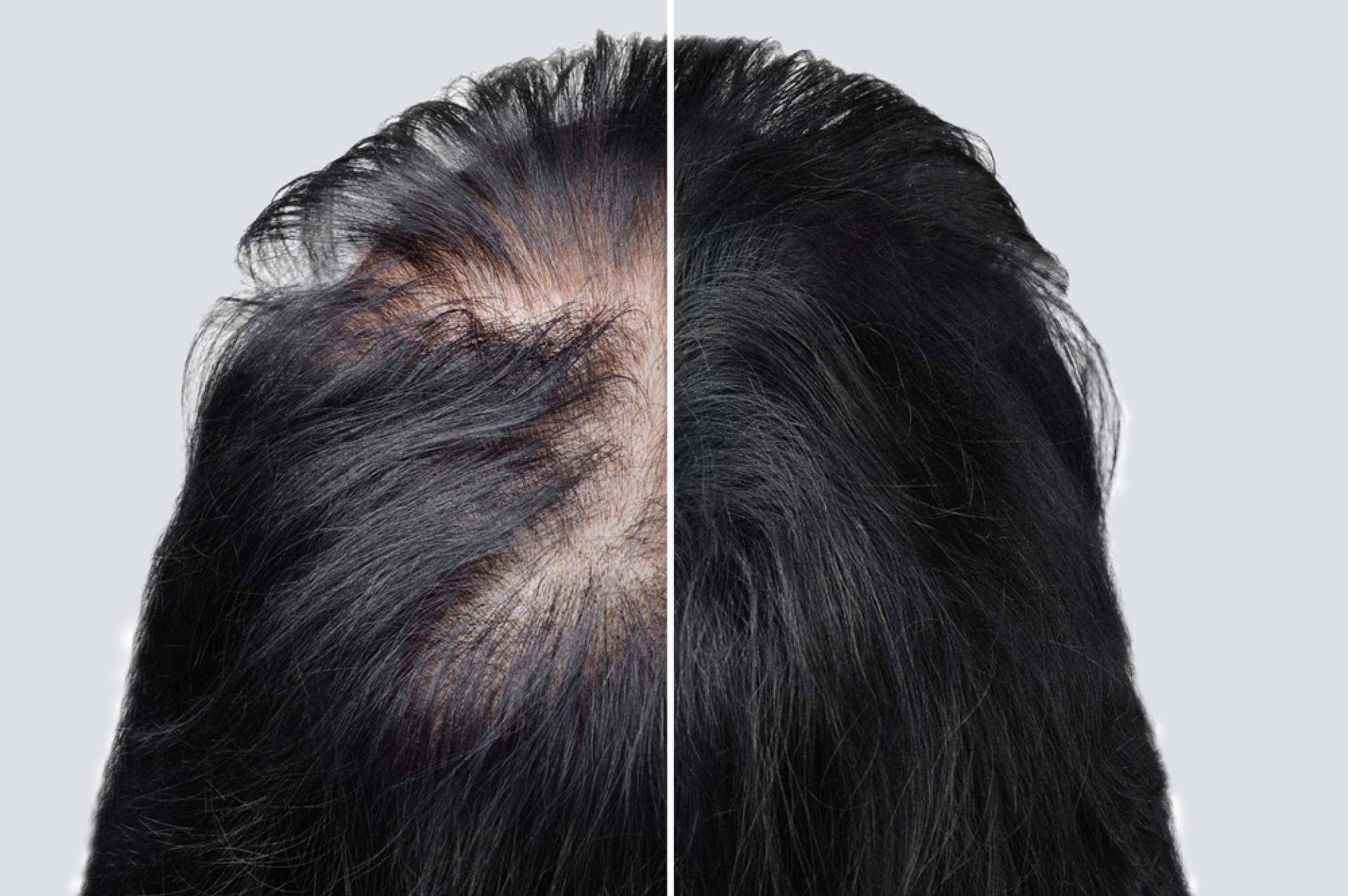 Tratamientos para la alopecia androgénica con Saw Palmetto