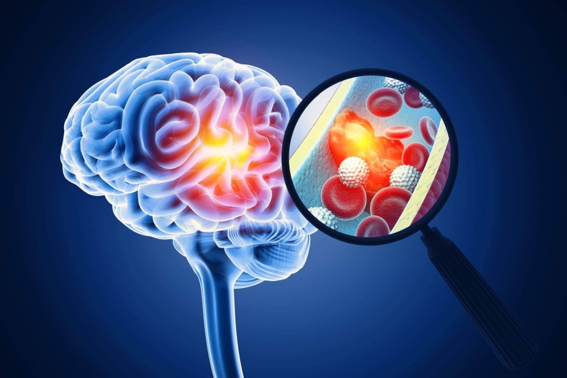 Detectar un ictus a tiempo, una intervención rápida mejora la supervivencia y la autonomía